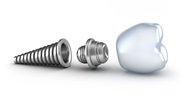 Single Tooth Dental Implant at Smile Dental Group