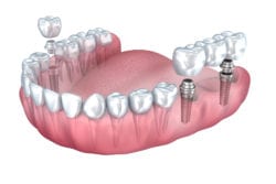 Multiple Teeth Dental Implants at Smile Dental Group
