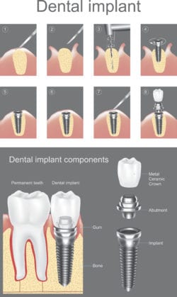 dental implants process palmdale and lancaster ca