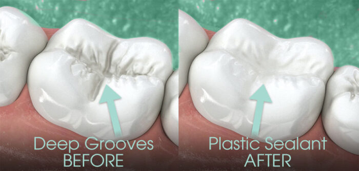 Why Your Tooth Needs a Sealant Why Your Tooth Needs a Sealant